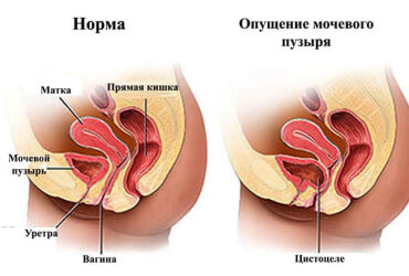 Консервативные подходы к лечению цистоцеле